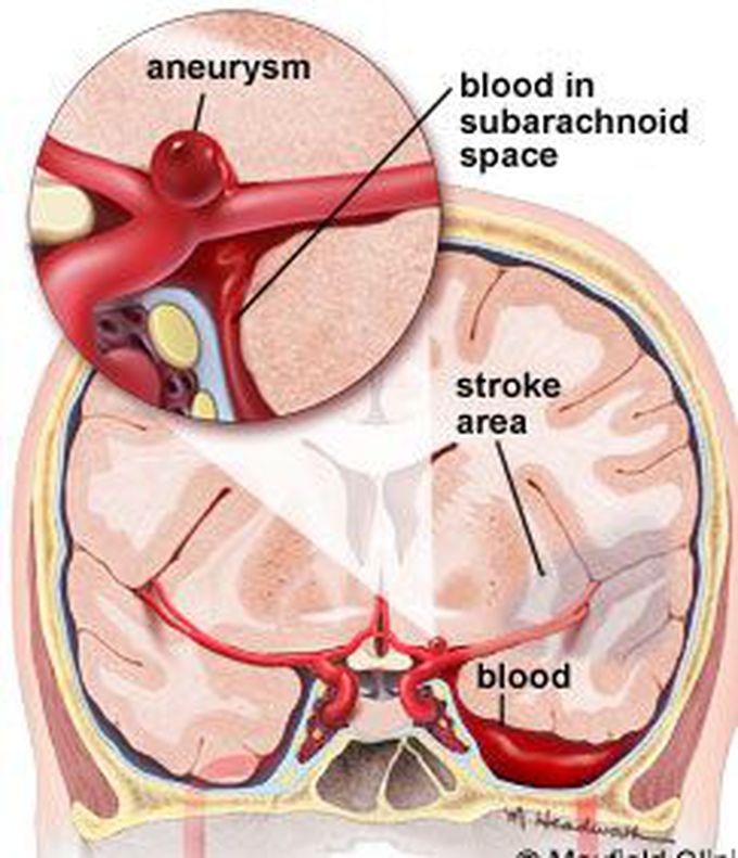 Aneurysm in the Brian - MEDizzy