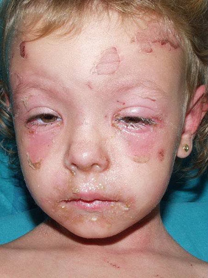 STAPHYLOCOCCAL SCALDED SKIN SYNDROME