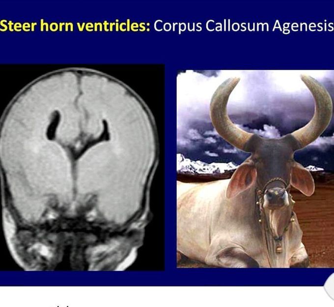 corpus callosum agenesis