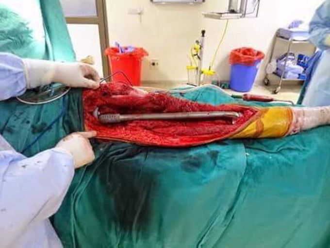Procedure known as ?