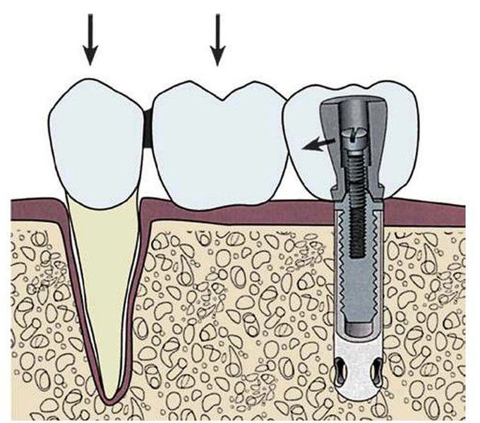 Single implant