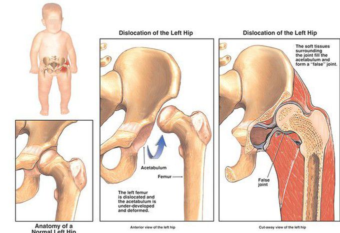 Congenital dislocated hip.