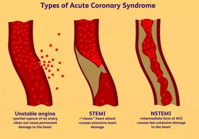 Types of ACS