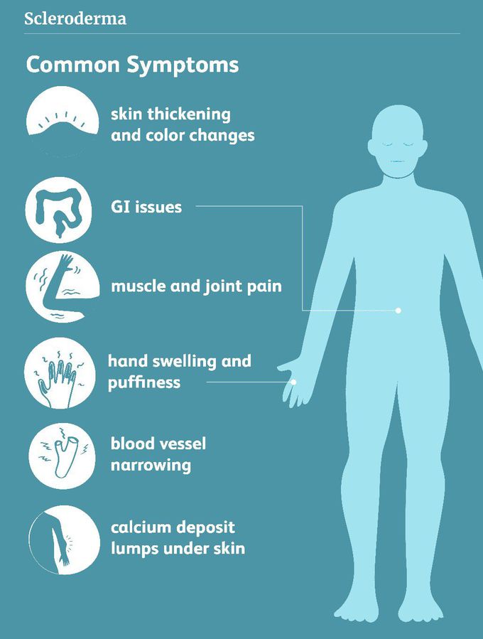 Symptoms of Scleroderma