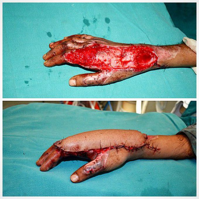 Reconstructive Surgery/skin Grafting After Road Traffic Accident