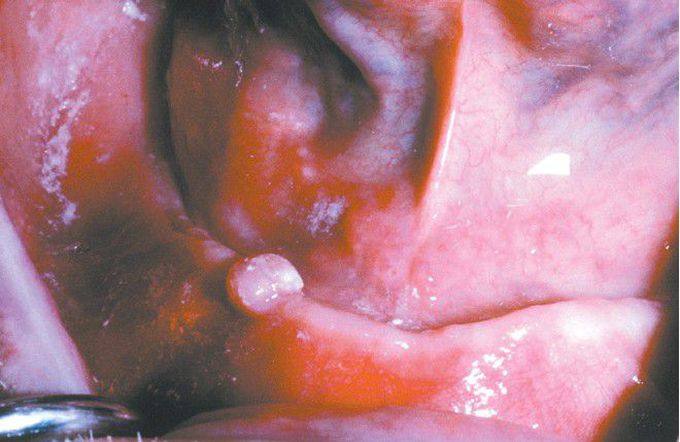 Periosteal Hyperplasia with Osseous And Chondromatous Metaplasia.