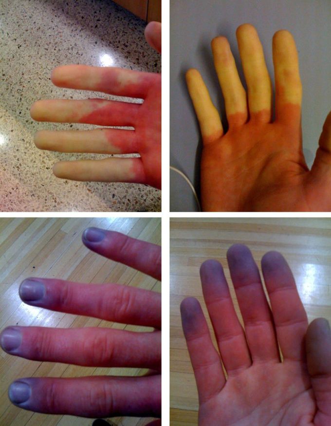 Raynaud's disease