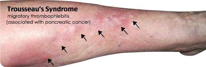 Trousseau syndrome