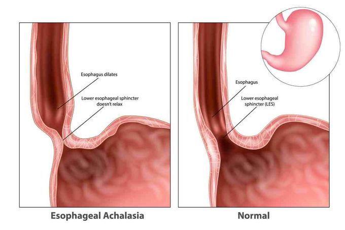 Esophageal Achalasia