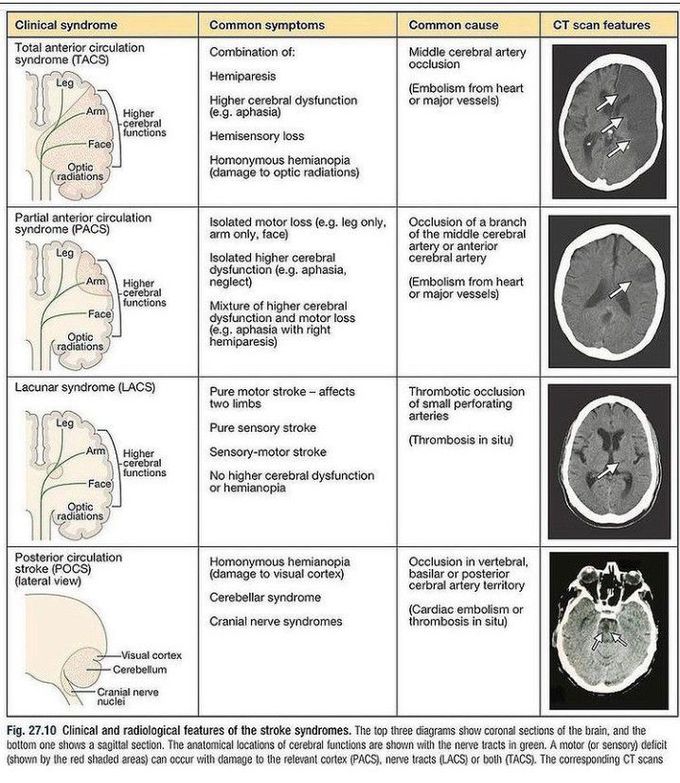 lacunar stroke syndromes