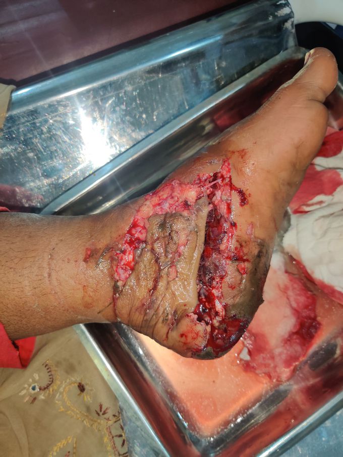 Traumatic laceration to foot