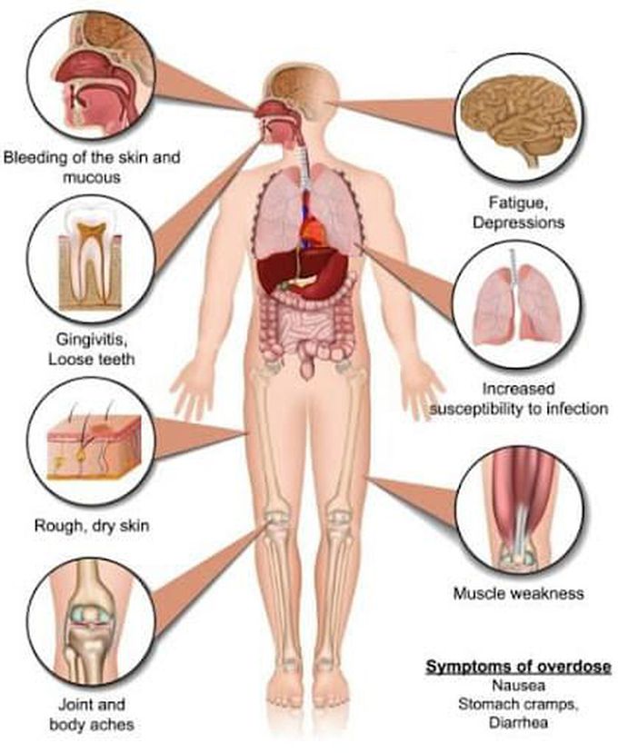 Vitamin C deficiency