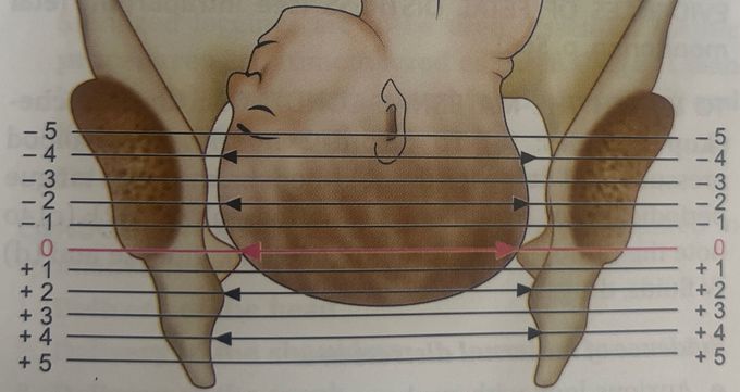 Station of the head in relation to ischial spines