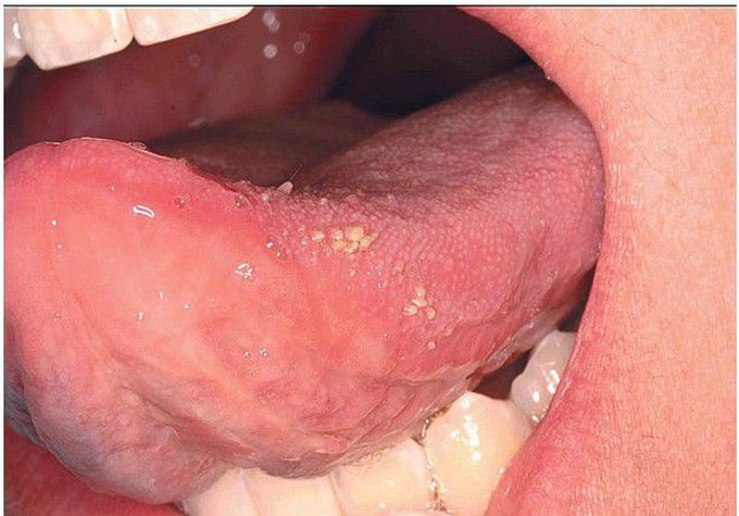 Transient Lingual Papillitis.