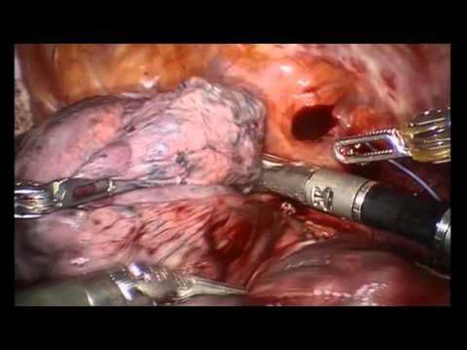 Robotic Lobectomy using a Sub-Xiphoid Approach