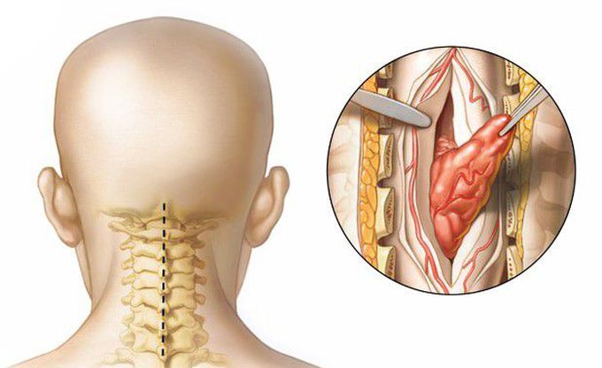 Treatment for Spinal tumor