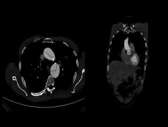 Reimplantation of Tricuspid Aortic Valve in Patient With Type I DeBakey Acute Aortic Dissection