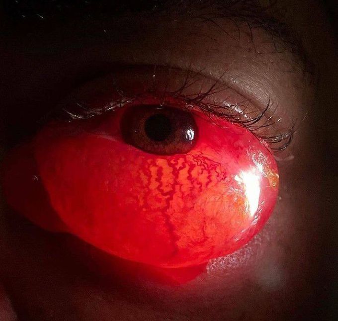 CONJUNCTIVAL CHEMIOSMOSIS