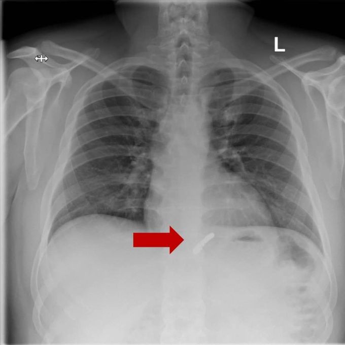 LINX Reflux System