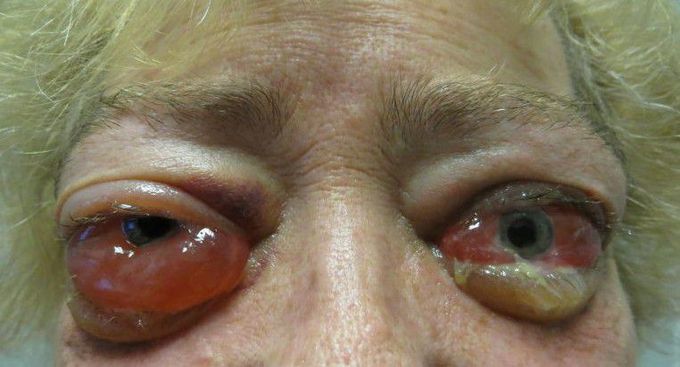 Thyroid Associated Ophthalmopathy!!!