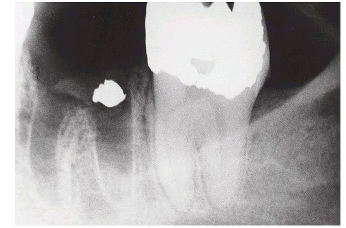 Post extraction complication