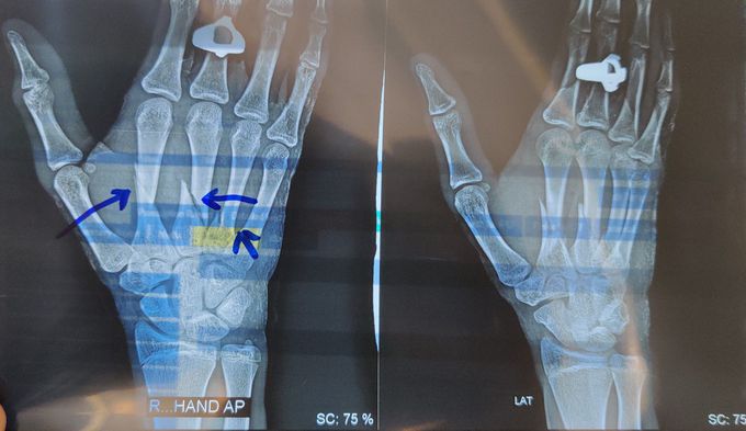 Fracture 2nd 3rd and 4th Metacarpal