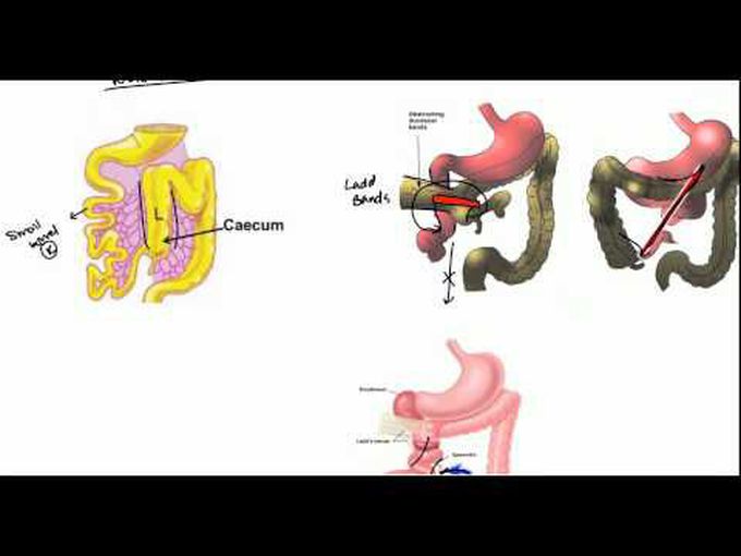 Rotation of the gut