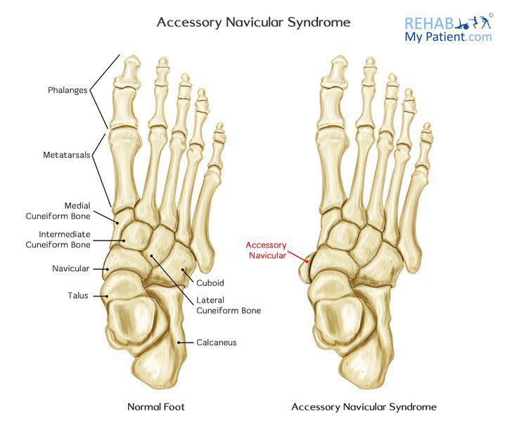 Accessory Navicular Bone (AKA~ Accessory Navicular Syndrome, Navicular Secundum)