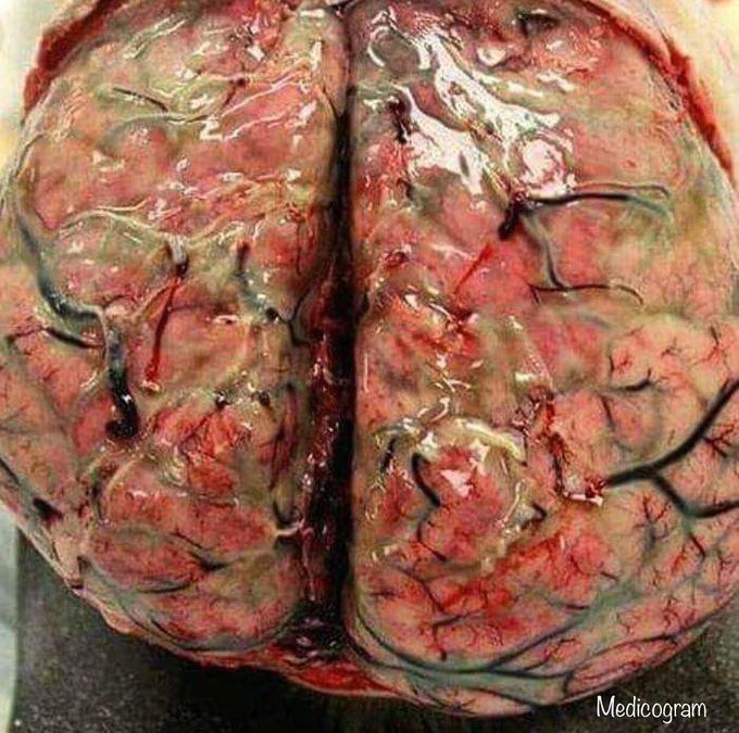 Bacterial Meningitis