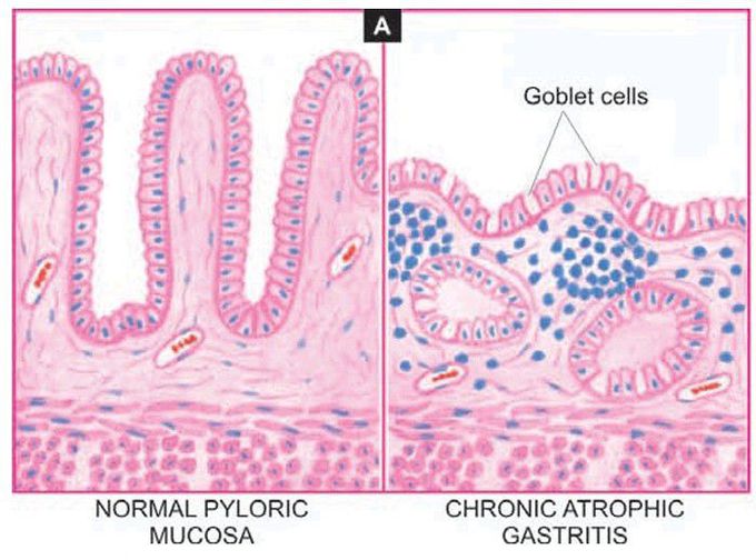 Gastritis vs normal gastric mucosa