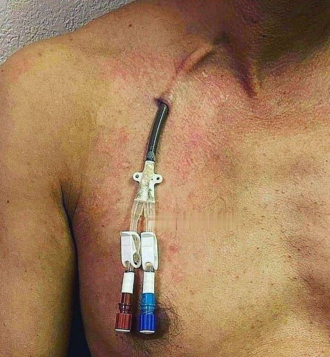 cardiovascular surgery
