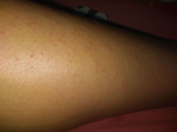 Patient presents with a rash over calf.Diagnosis?