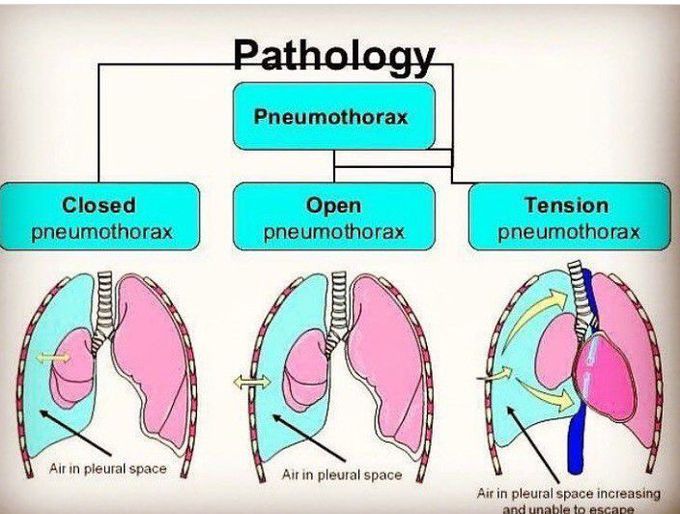 Pnemothorax