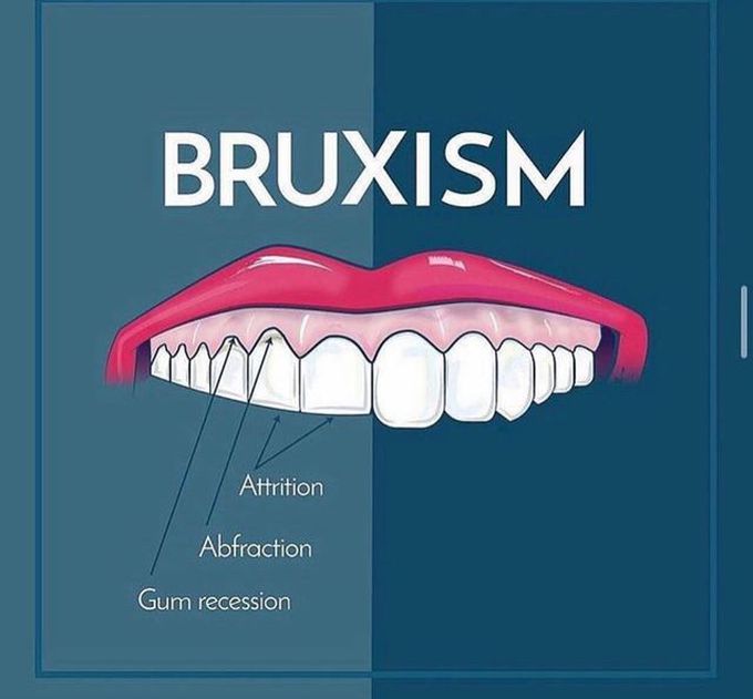 Bruxism