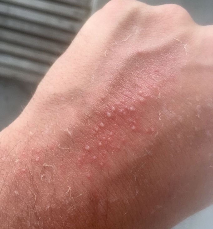 Condition and treatmeant?