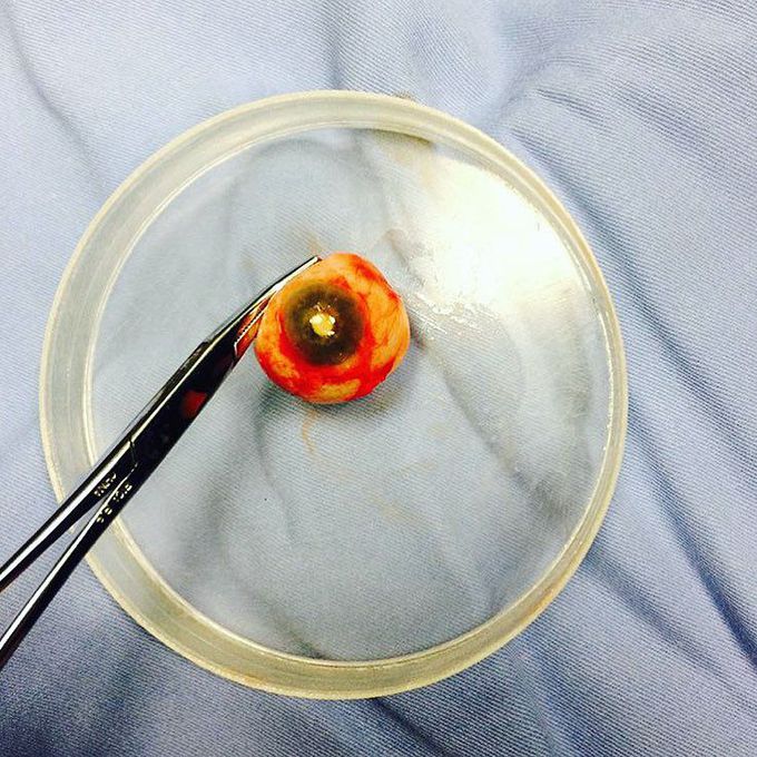 Real eye from a 55-year-old woman who suffered from glaucoma for a long time