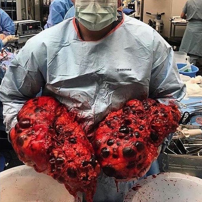 Polycystic Kidney