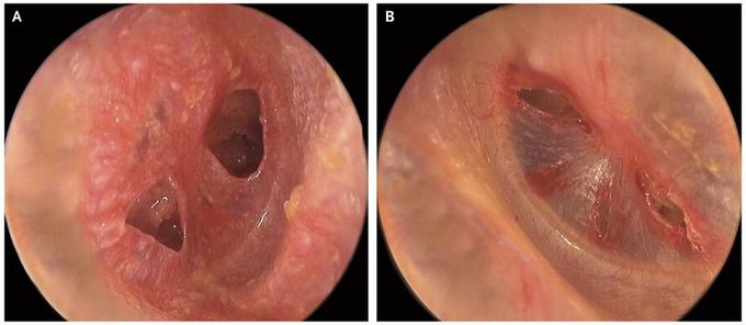 Binaural Tympanic-Membrane Perforations after Blast Injury