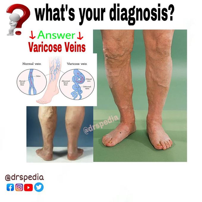 Varicose veins