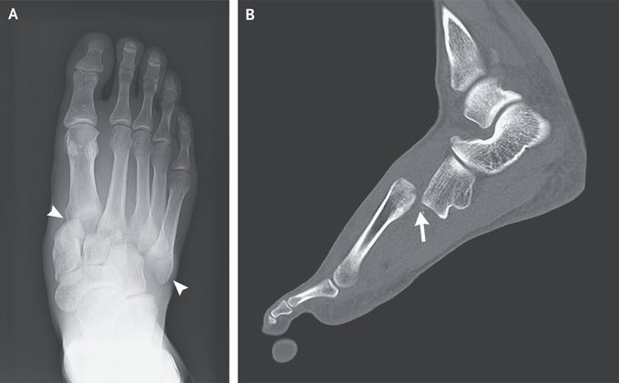 Lisfranc Injury