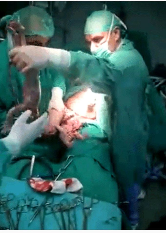 Amazing!!! 6Babies delivered by Caesarian Section..