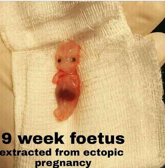9 week foetus