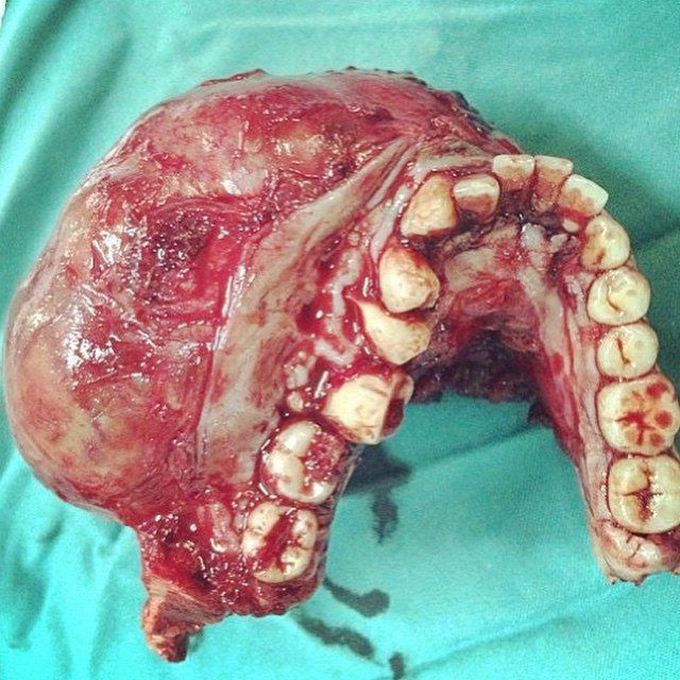 Removal of Squamous cell carcinoma along with Mandibular jaw bone