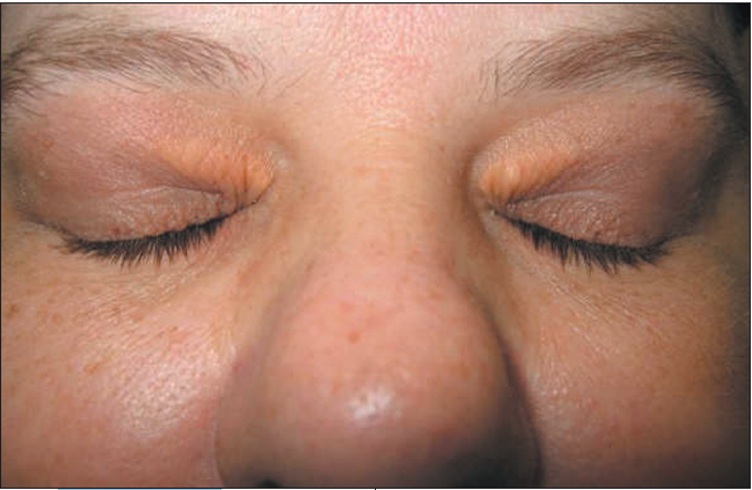 Xanthelasma