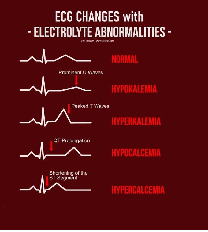 ECG Changes with Electrolyte Abnormalities