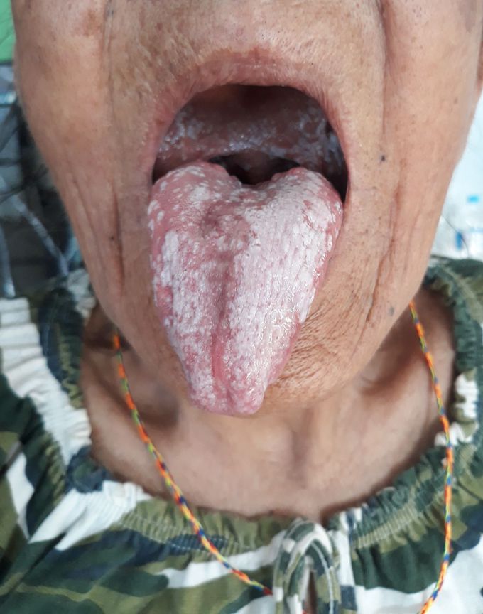 She's a known case of COPD and is under medication ! What is Diagnosis ? What might be the pathophysiology of this disease
