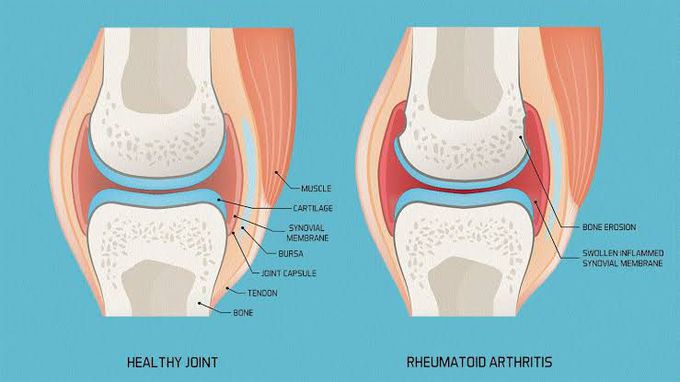 Symptoms of rheumatoid arthritis