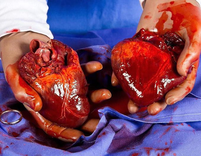 Hearts before transplant