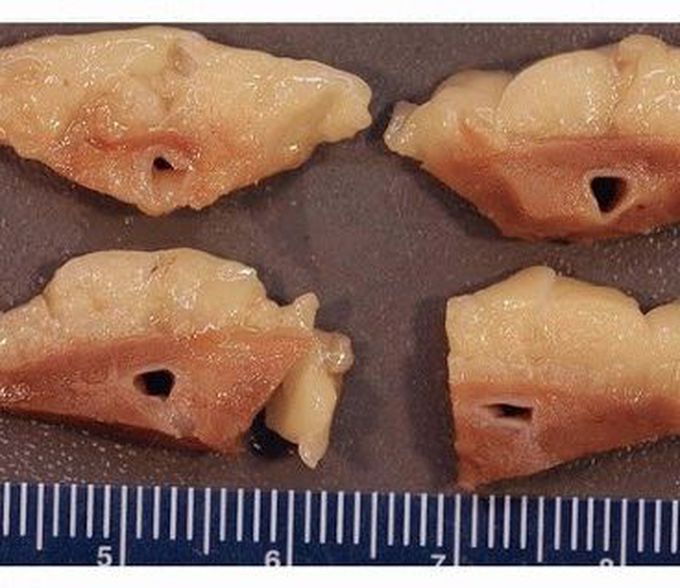 Myocardial Bridging