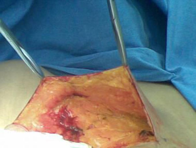 Mastectomy